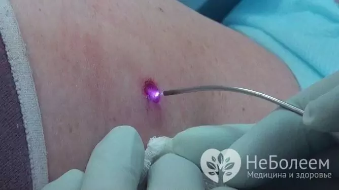 Papilomas, condilomas e verrugas causadas por HPV em uma mulher são removidos com sucesso com um laser