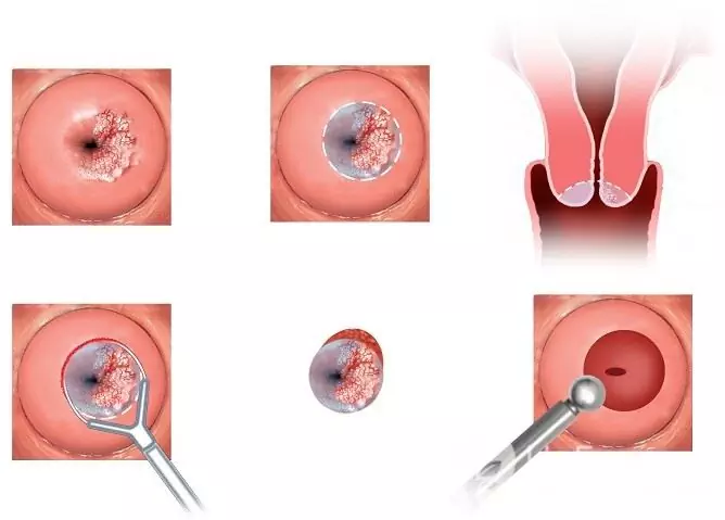 La conización del cuello uterino es un tipo de tratamiento quirúrgico para el daño del cuello uterino con el virus del papiloma humano