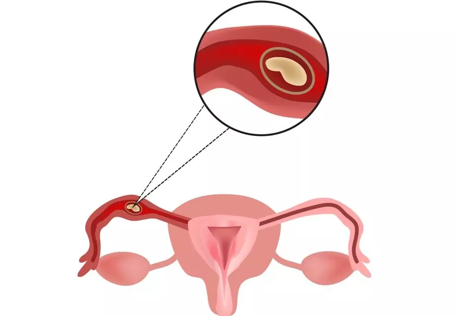 Ectopic Pregnancy: Signs, Treatment, Causes