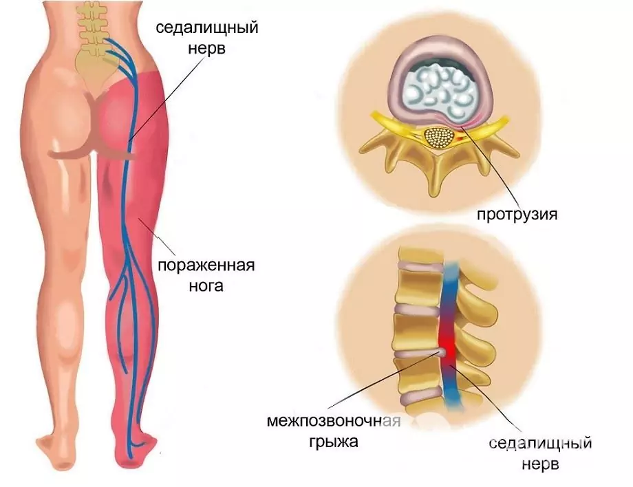 Sinais de inflamação do nervo ciático