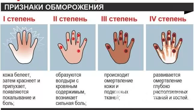 Degrees and signs of frostbite