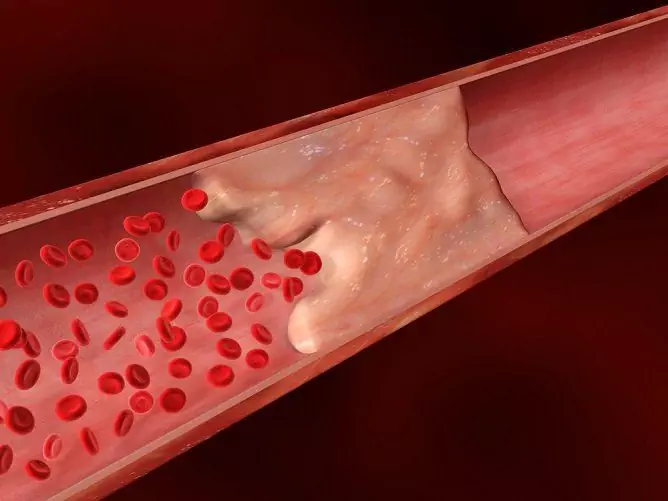 Embolisme Lemak, Emboli Pulmonari Lemak, Embolisme Lemak Pada Patah Tulang