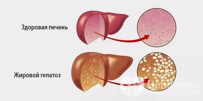 Vad är fet hepatos?