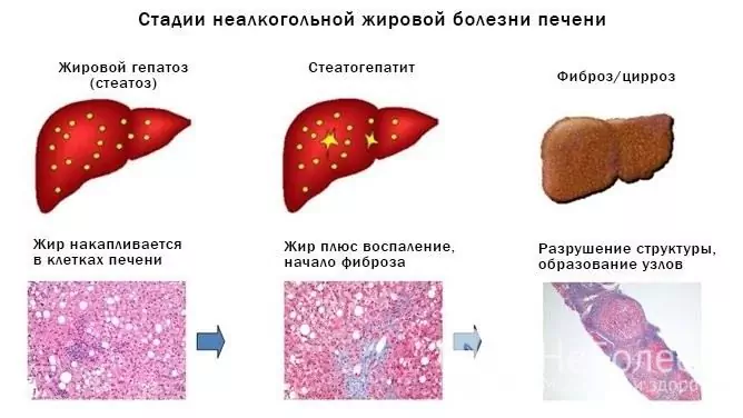 Možné následky a komplikácie tukovej hepatózy