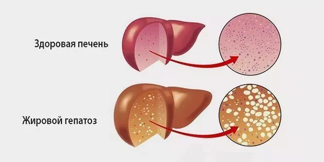 Mastná Hepatóza - Príznaky, Liečba Pečene, Strava, Príznaky