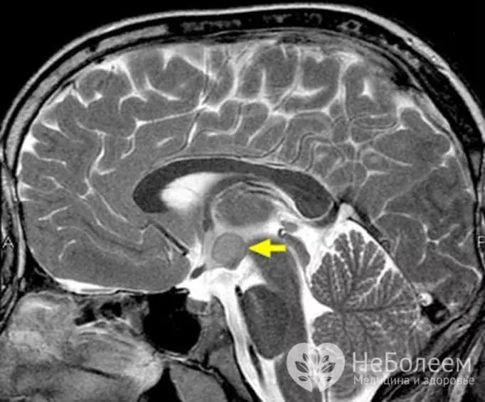 Signs of hypothalamic hamartoma