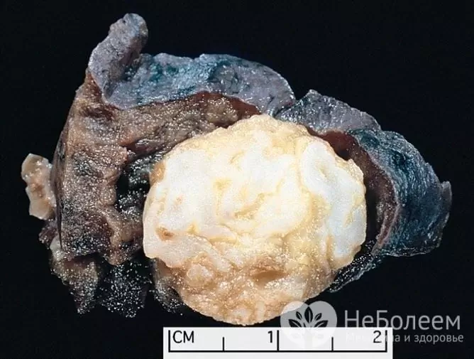 Hamartoma of the lung