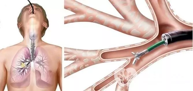 Se realiza una broncoscopia para diagnosticar el hamartoma pulmonar