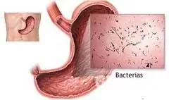 Causas de gastroenterite