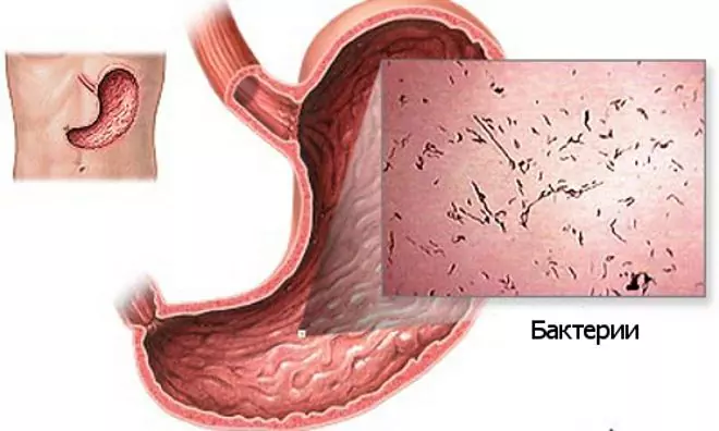 Gastroenteritt Hos Barn - Symptomer, Behandling, Akutt Gastroenteritt Hos Barn