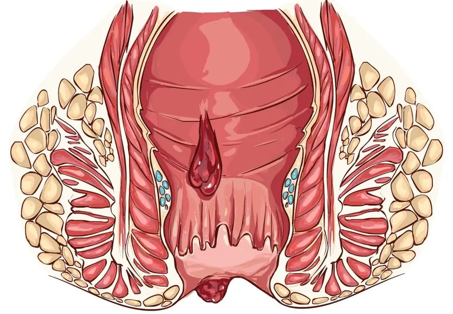 Hemorroides En Mujeres: Síntomas, Tratamiento, Signos, Causas