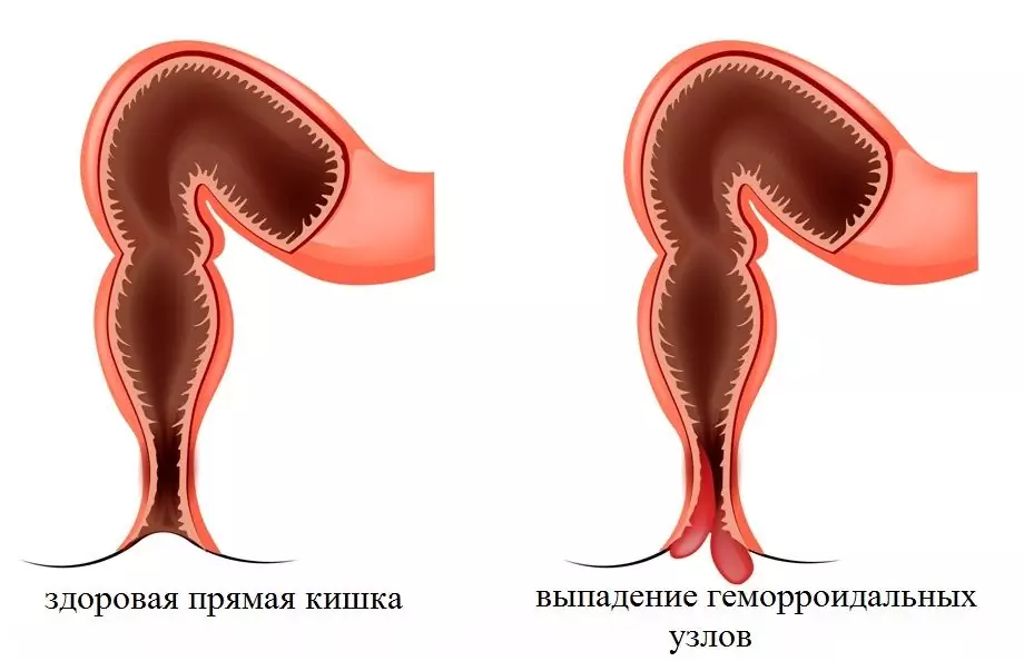 Hemoroidi Pri Moških - Simptomi, Zdravljenje, Znaki, Vzroki