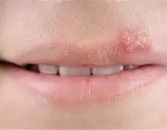 Herpes Vírus Terhes Nőknél - Kezelés, Tünetek