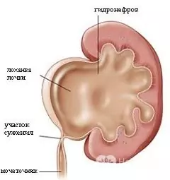 Hydronephrosis