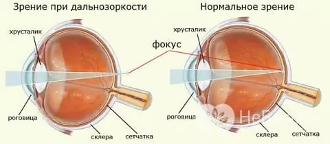 Nadwzroczność (dalekowzroczność)