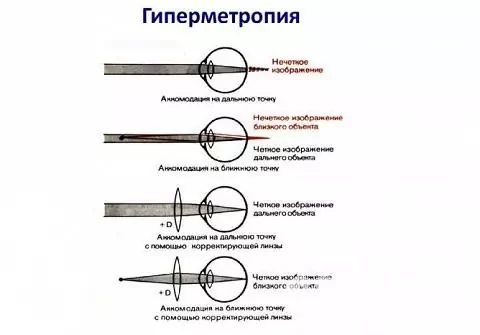 Hyperopian oireet