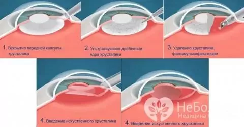 Schimb de lentile refractive