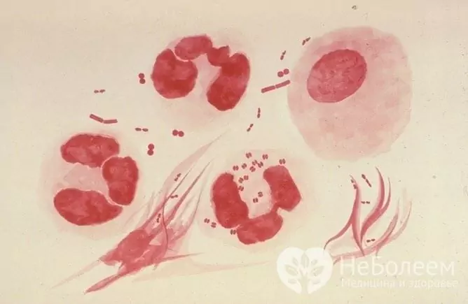 Gonococcus Neisseria gonorrhoeae - det orsakande medlet för gonorré