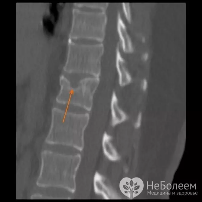 Schmorl's hernia on X-ray