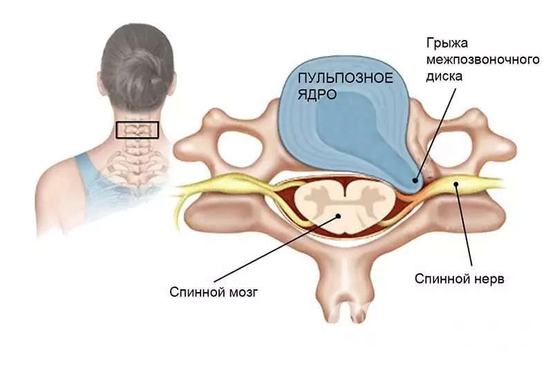 Segni di un'ernia del rachide cervicale