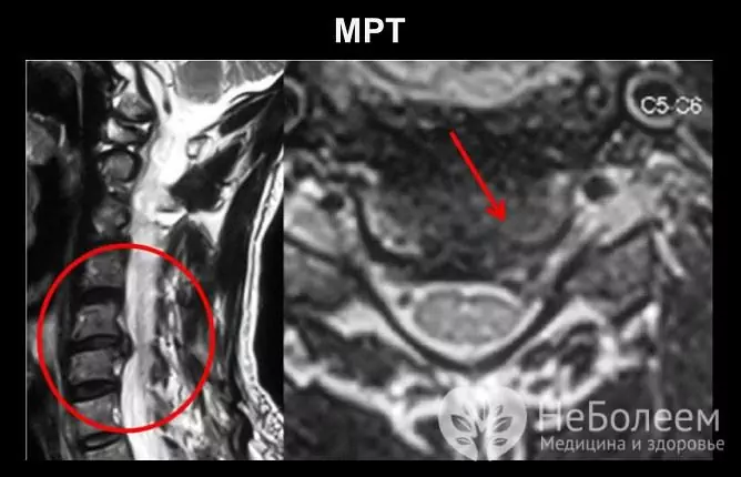 Hernia de la columna cervical C5-C6 en MRI