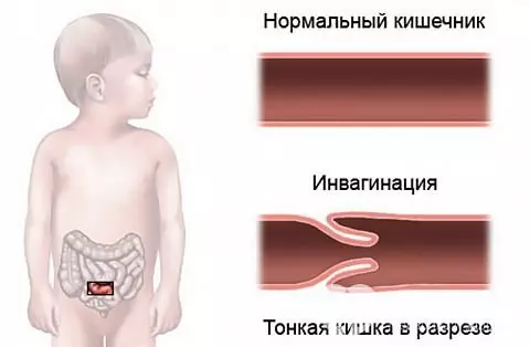 Signos de invaginación intestinal