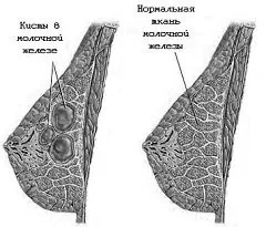 Mastopati - Symptomer, Typer, Behandling