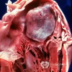 Myxoma adalah tumor jinak dengan bentuk tidak teratur