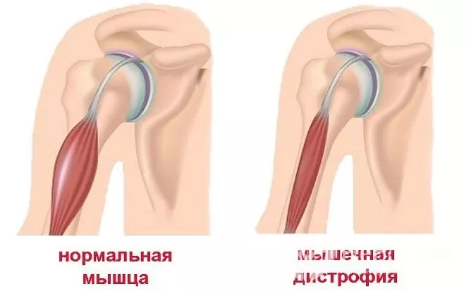 Myopathy is characterized by muscular dystrophy and then atrophy