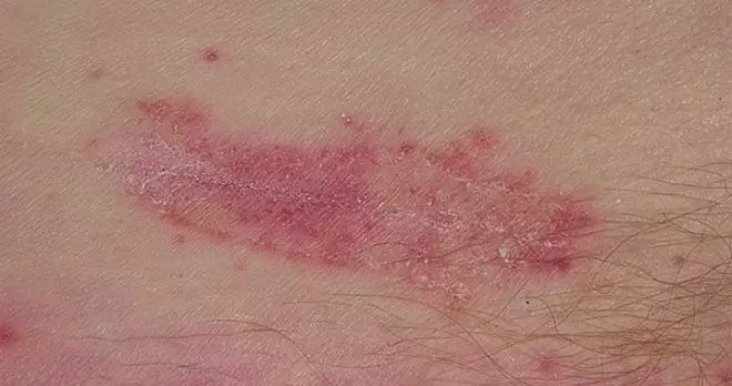 Candidiasis Van De Huid - Behandeling, Candidiasis Van De Gezichtshuid, Candidiasis Van De Huid Bij Kinderen