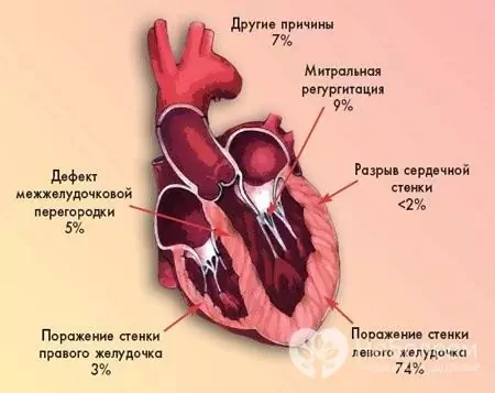 Główne przyczyny wstrząsu kardiogennego