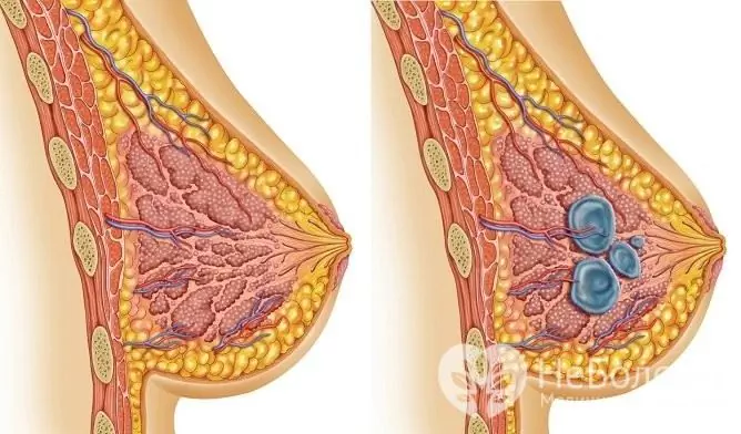 Cysta prsu je jedním z projevů fibrocystické mastopatie