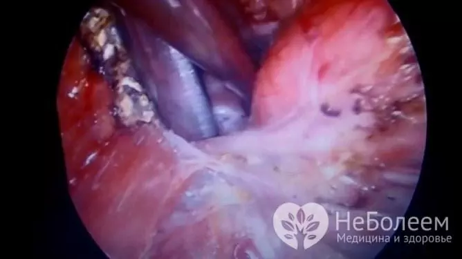 Dalam beberapa kasus, satu (dipengaruhi oleh kista) lobus kelenjar tiroid diangkat - hemithyroidectomy