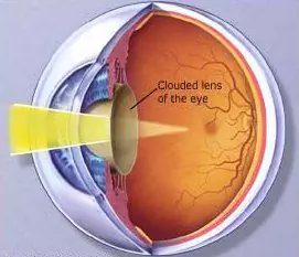 Night Blindness - Treatment, Symptoms, Diagnosis