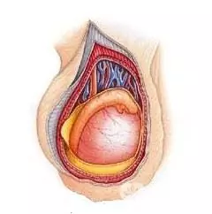 Orchitis - ontsteking van de zaadbal