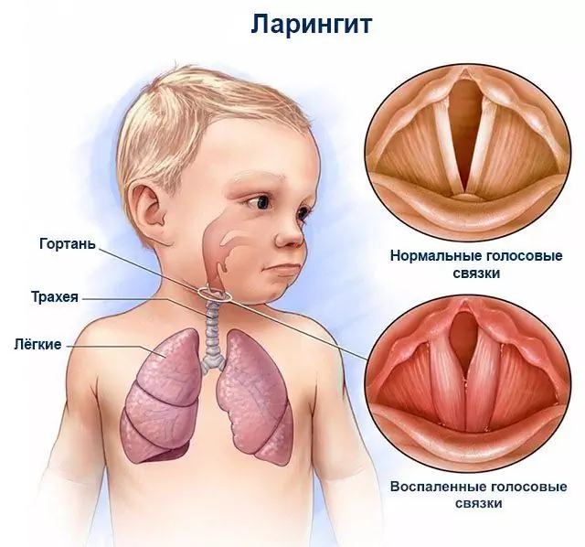 Laringitis Pri Otrocih - Simptomi, Zdravljenje, Vzroki, Akutni Laringitis Pri Otrocih