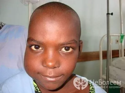 Burkitt's lymphoma is common in children, especially in Africa, which accounts for 80% of all cases