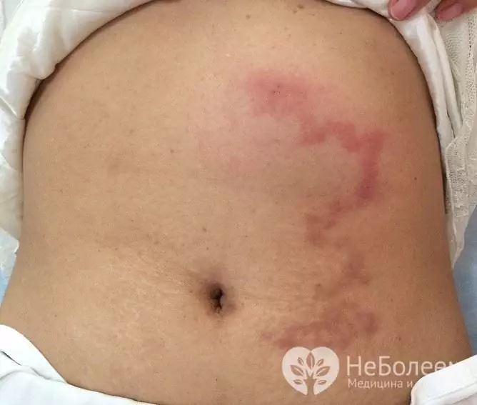 Panniculitis lebih kerap berlaku pada anggota badan, tetapi juga boleh mempengaruhi batang badan