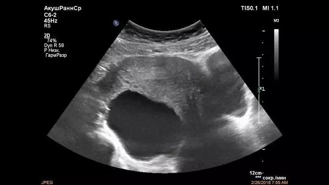 Cisti Ovarica Paraovarian: Cause, Trattamento, Foto