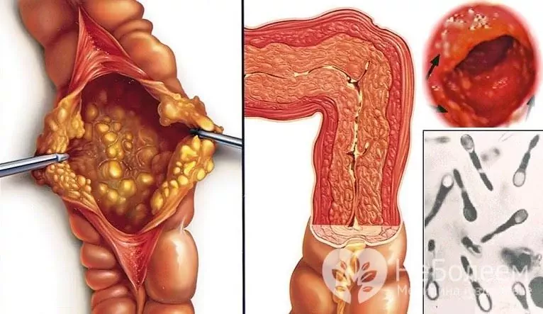 Segni di colite pseudomembranosa