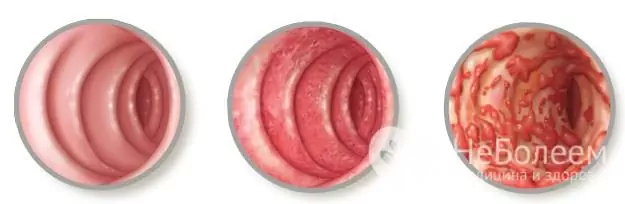 Vormen van pseudomembraneuze colitis