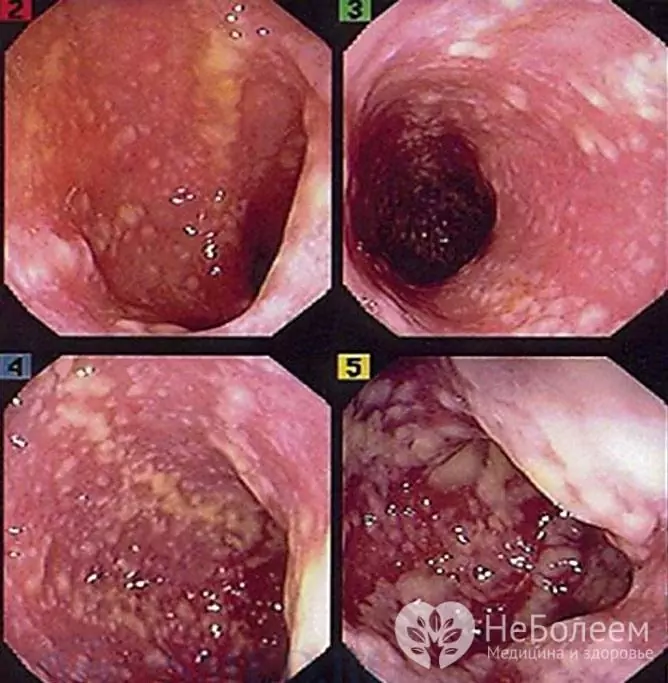 Colitis pseudomembranosa colonoscópica