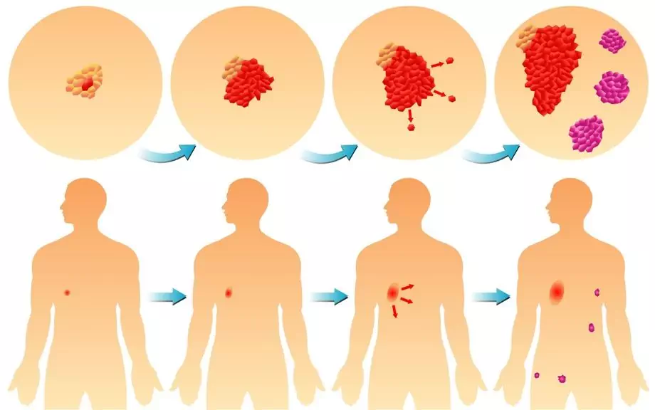 Malignant Tumor - Symptoms, Treatment, Forms, Stages, Diagnosis