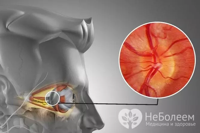 La inflamación del nervio óptico conduce a una discapacidad visual