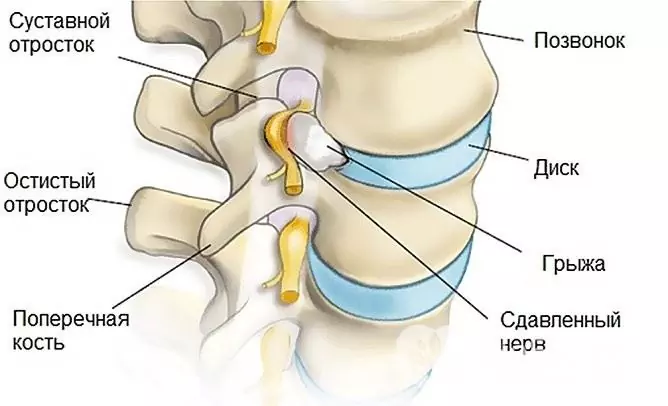 Radikuliit tekib intervertebraalse hernia moodustumise tagajärjel