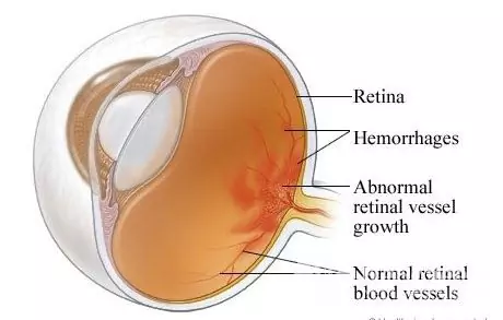 Retinopathie