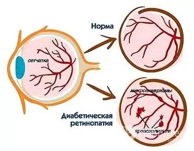 Diabetisk retinopati