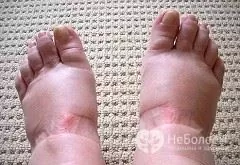 Edema adalah salah satu tanda gestosis