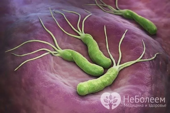 L'infezione da Helicobacter Pylori è la causa più comune di gastroduodenite cronica