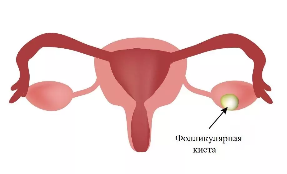 Follicular Ovarian Cyst - Symptoms, Treatment, Causes